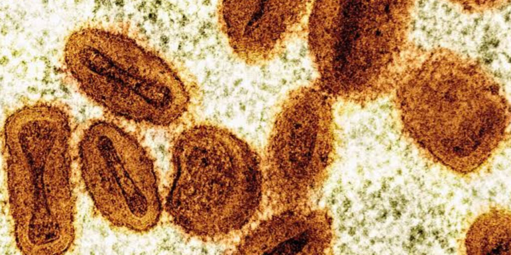 UK Reports New Case of Dangerous Mpox Variant Clade 1b UK Reports New Case of Dangerous Mpox Variant Clade 1b