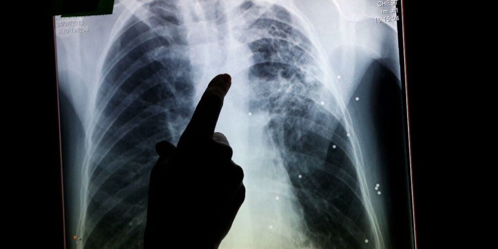 England Faces Alarming TB Spike Amid Poverty Concerns England Faces Alarming TB Spike Amid Poverty Concerns