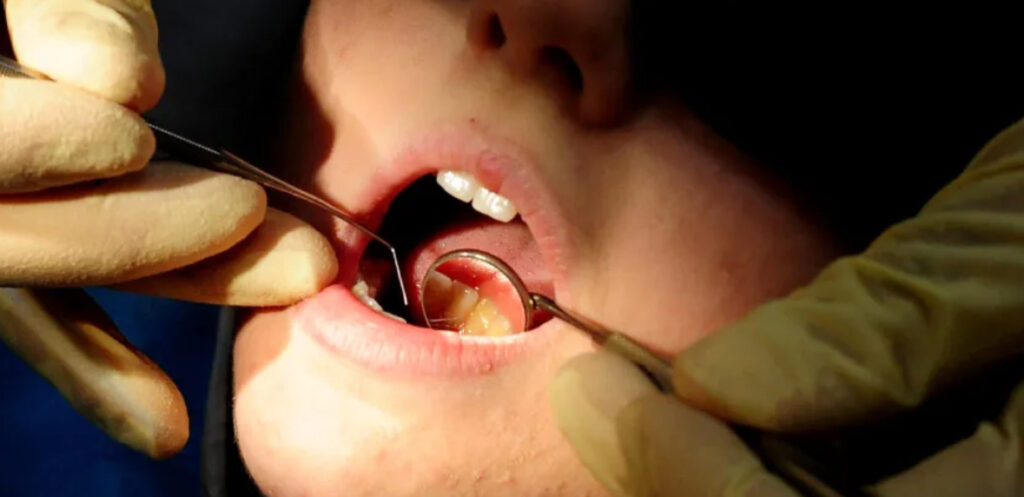 14 Million Adults Unable to Access NHS Dental Care in England