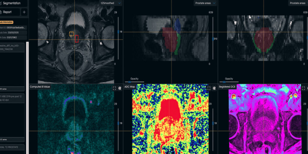 NHS Expands AI Prostate Cancer Diagnosis Across England