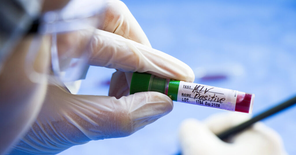 HIV Diagnoses Drop by 4% Across UK